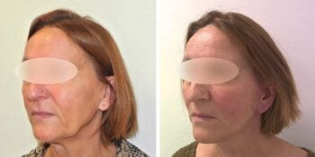 facelift voor en 3 maanden na de operatie uitgevoerd door dr van der weij 14 linker zijkant