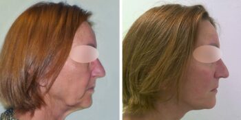 facelift voor en 3 maanden na de operatie uitgevoerd door dr van der weij 14 rechterkant