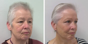 facelift voor en 3 maanden na de operatie uitgevoerd door dr van der weij 15 rechterkant