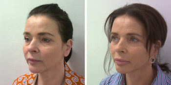 facelift voor en 3 maanden na de operatie uitgevoerd door dr van der weij 16 linkerkant