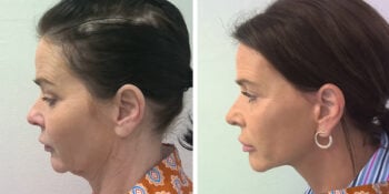 facelift voor en 3 maanden na de operatie uitgevoerd door dr van der weij 16 linkerkant