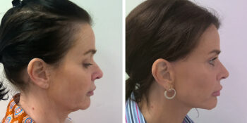 facelift voor en 3 maanden na de operatie uitgevoerd door dr van der weij 16 dwars rechterkant