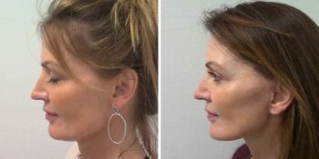 21 facelift voor en 3 maanden na de operatie uitgevoerd door dr van der weij linker dwars