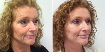 30 beautiful dr van der weij facelift met boven en onderooglidcorrectie voor en na rechterkant. 54 jaar