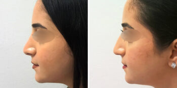 46 beautiful dr van der weij neuscorrectie bij een vrouw voor en na linkerkant