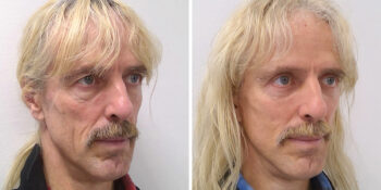 31 beautiful dr van der weij facelift met boven en onderooglidcorrectie voor en na rechts. 59 jaar