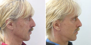 31 beautiful dr van der weij facelift met boven en onderooglidcorrectie voor en na rechts dwars. 59 jaar