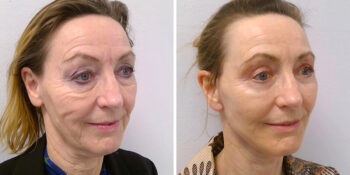 32 beautiful dr van der weij facelift met boven en onderooglidcorrectie voor en na voorkant. 64 jaar rechts