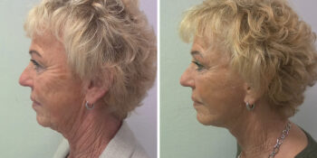 33 beautiful dr van der weij facelift voor en na foto links dwars
