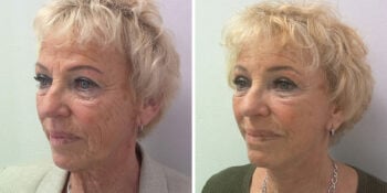 33 beautiful dr van der weij facelift voor en na foto links