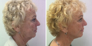 33 beautiful dr van der weij facelift voor en na foto rechts dwars