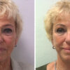 33 beautiful dr van der weij facelift